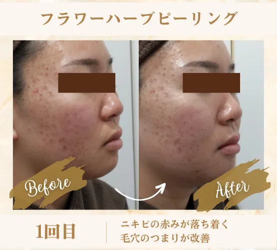 フラワーハーブピーリング 1回目の変化 ニキビの赤みが落ち着き毛穴のつまりも改善